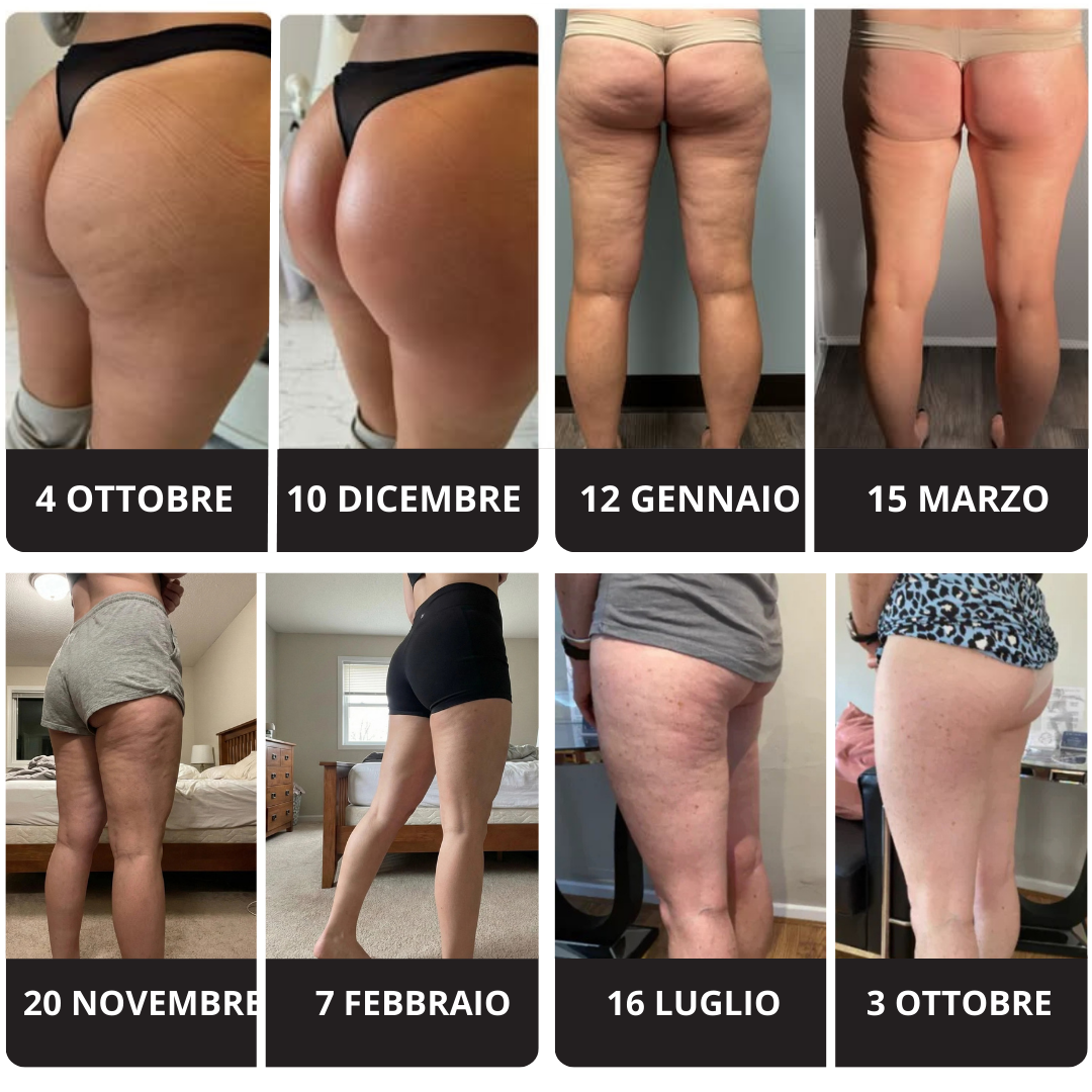 Sooftie | Calze Drenanti per Cellulite e Lipedema
